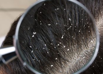 Saçdakı kəpəkdən necə qurtulmaq olar? Səbəbləri və effektiv qulluq üsulları