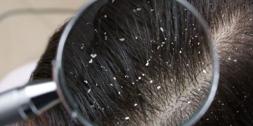 Saçdakı kəpəkdən necə qurtulmaq olar? Səbəbləri və effektiv qulluq üsulları