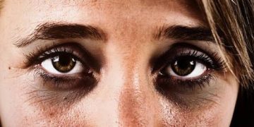 Göz altındakı qaralmaların əsas səbəbləri – bunu bilməlisiniz