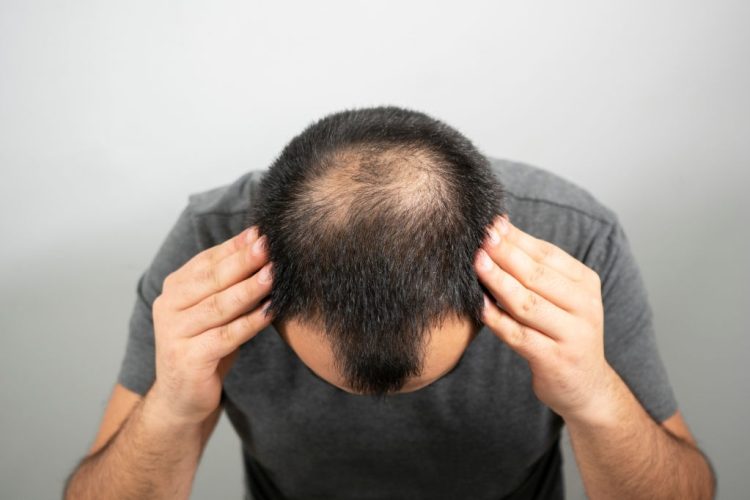 sparse, hair, bald, head, problem,