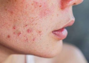 Üzdə sızanaqlar niyə yaranır və necə azaltmaq olar? Effektiv qulluq qaydaları