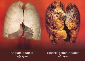 Siqareti tərgidəndə orqanizmdə nə baş verir? Günbəgün dəyişikliklər