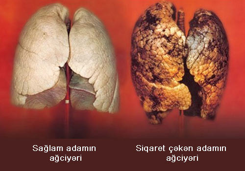 Siqareti tərgidəndə orqanizmdə nə baş verir? Günbəgün dəyişikliklər